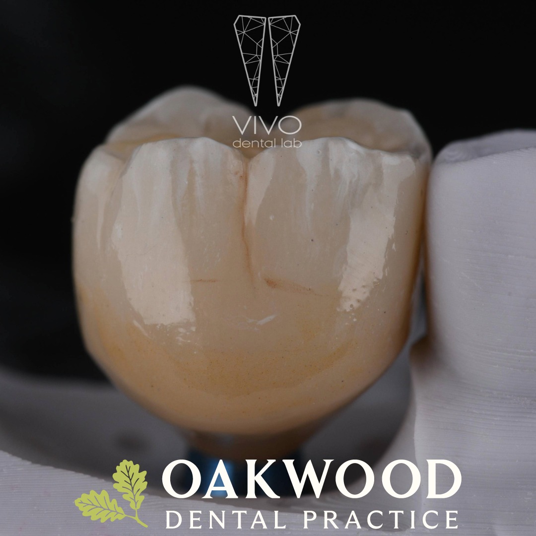 Missing a tooth? Dental implants are a long-lasting, natural-looking way to restore your smile.
At Oakwood Dental Practice, your implant journey is completed in-house using advanced digital planning and personalised care every step of the way.
Book your consult#healthysmile 
@vivodentallab 
#DentalImplants #OakwoodDental #SmileRestoration #DigitalDentistry #HealthySmile